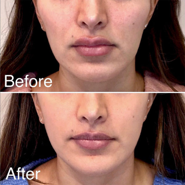 The Smackdown on Lip Augmentations New York Social Diary